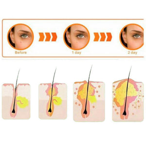 36pcs  Pimple Master Patch Acne Treatment | Buy From T