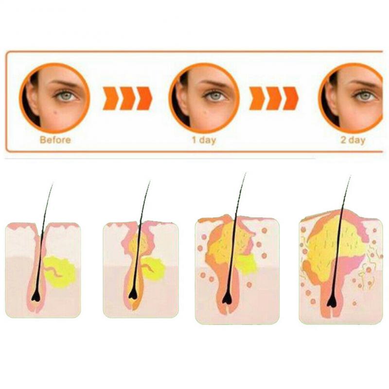 36pcs  Pimple Master Patch Acne Treatment | Buy From T