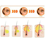 36pcs  Pimple Master Patch Acne Treatment | Buy From T