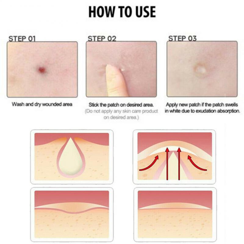 36pcs  Pimple Master Patch Acne Treatment | Buy From T