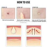 36pcs  Pimple Master Patch Acne Treatment | Buy From T