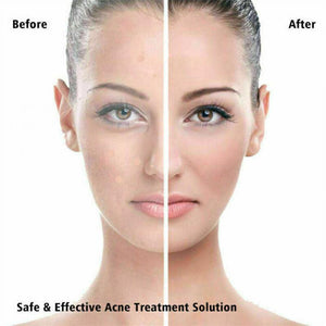 36pcs  Pimple Master Patch Acne Treatment | Buy From T