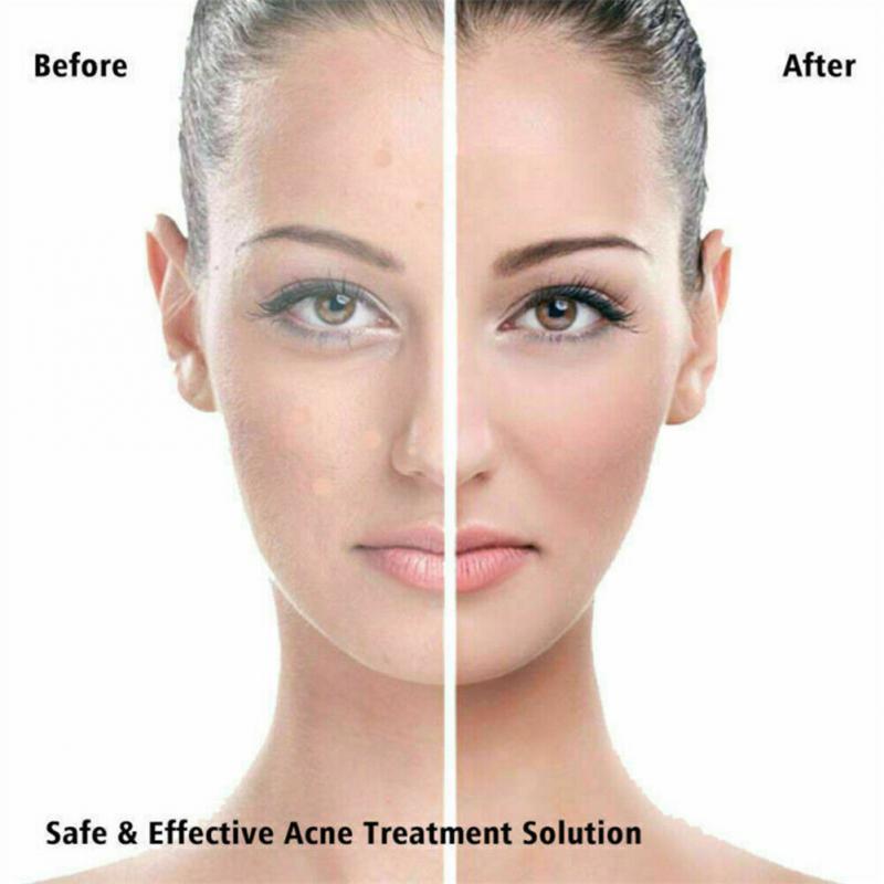 36pcs  Pimple Master Patch Acne Treatment | Buy From T